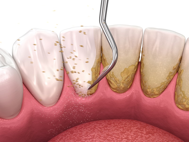 Răng sứ vẫn cần cạo vôi định kỳ 3–6 tháng/lần như răng thật,