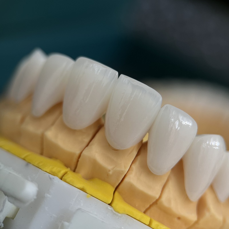 Không cạo vôi sau khi bọc sứ có thể khiến mảng bám tích tụ quanh viền mão sứ, g