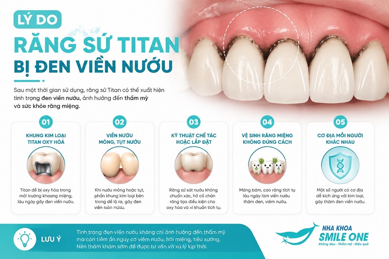 Răng sứ Titan bị đen viền nướu chủ yếu do phần lõi kim loại bên trong bị oxy hóa