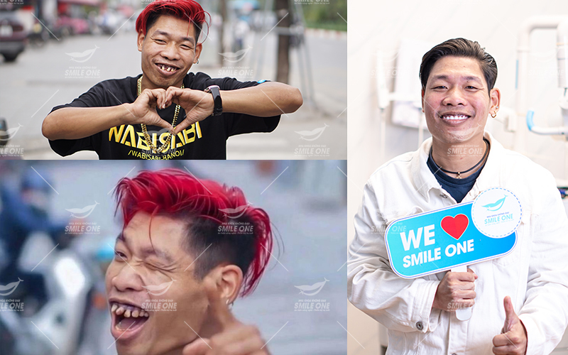 Kết quả làm lại răng sứ thẩm mỹ của Thông Soái Ca tại Nha khoa Smile One