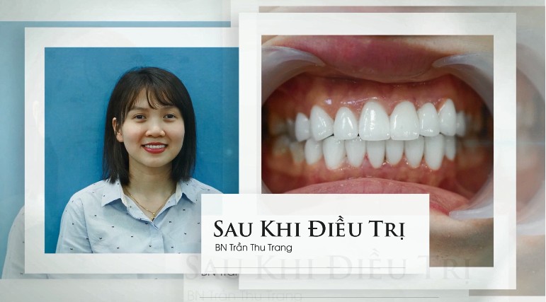 Chị Thu Trang — răng lệch trục, hình thể răng không đều,