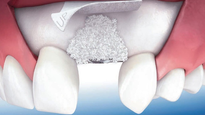 Mục tiêu là phục hồi thể tích xương rồi trồng lại răng để duy trì xương lâu dài.