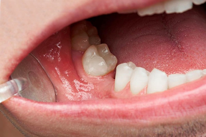 Mức độ tiêu xương quyết định phương pháp điều trị phù hợp