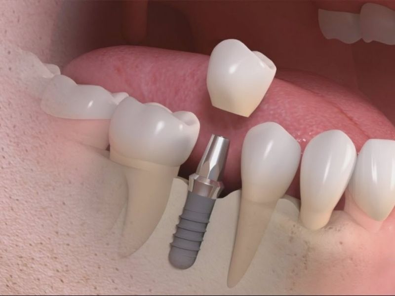 Có, một số gói bảo hiểm sức khỏe thương mại có quyền lợi nha khoa, khác với BHYT bắt buộc.