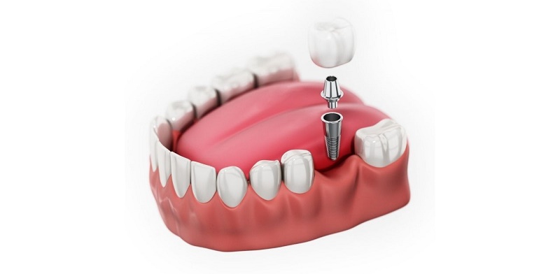 Implant là tiểu phẫu đặt trụ vào xương nên có thể sưng, đau nhẹ hơn cầu sứ, nhưng vẫn trong ngưỡng kiểm soát được.