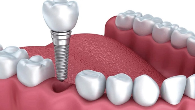 Trong lúc thực hiện, bạn gần như không đau nhờ được gây tê cục bộ
