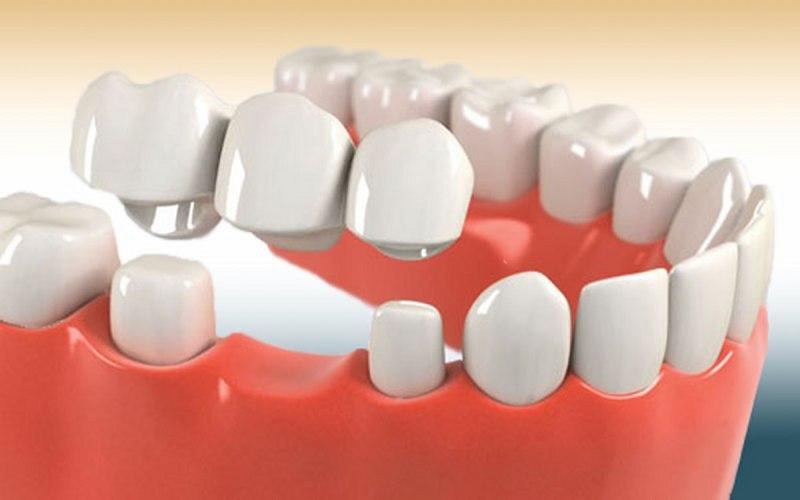 hần lớn khách trồng răng cố định ghi nhận cảm giác khó chịu tập trung