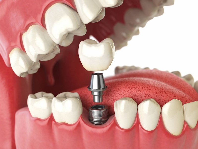 cấy ghép Implant là lựa chọn được đánh giá cao nhất