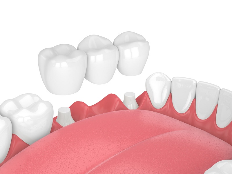 Implant có nhiều ưu điểm, nhưng không phải trường hợp