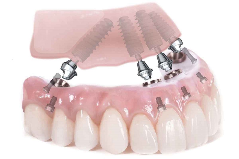 độ bền thực tế của mỗi người mỗi khác, vì nó phụ thuộc vào chất lượng trụ,