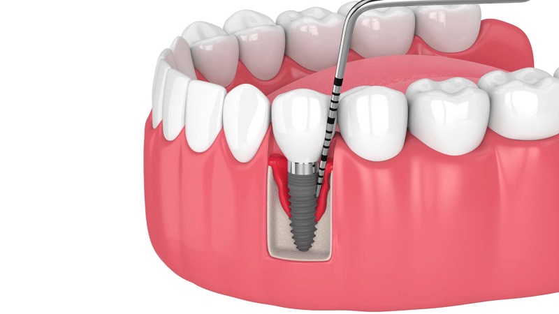 Những sai lầm thường gặp về tuổi thọ răng Implant