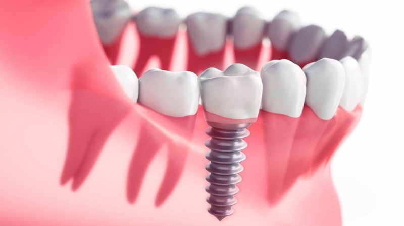 Vai trò của phim CT Cone Beam và máng hướng dẫn