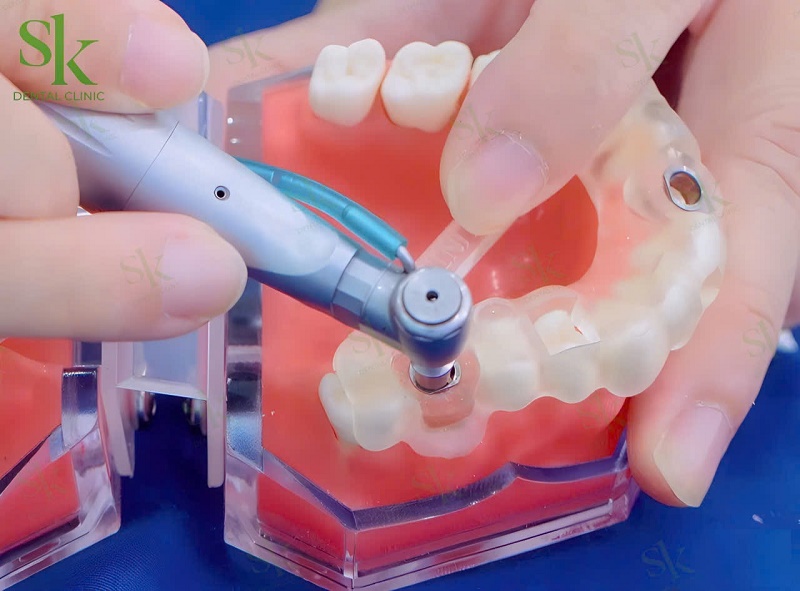 Khi trồng răng Implant, bác sĩ thường bắt buộc phải rạch lợi nếu cần mở rộng