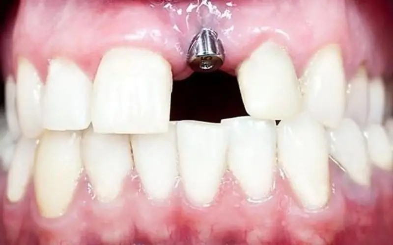 Trồng răng Implant không rạch lợi là kỹ thuật cấy ghép ít xâm lấn,