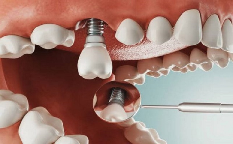 trường hợp khách hàng có thể niềng răng sau khi đã trồng Implant áp dụng cho các trụ lẻ ,