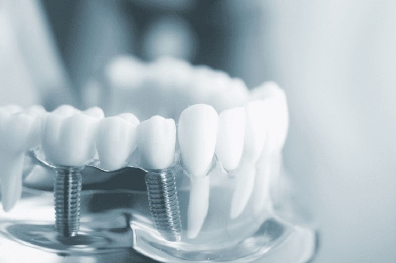 Rất nhiều trường hợp hoàn toàn có thể niềng răng sau khi đã trồng răng Implant
