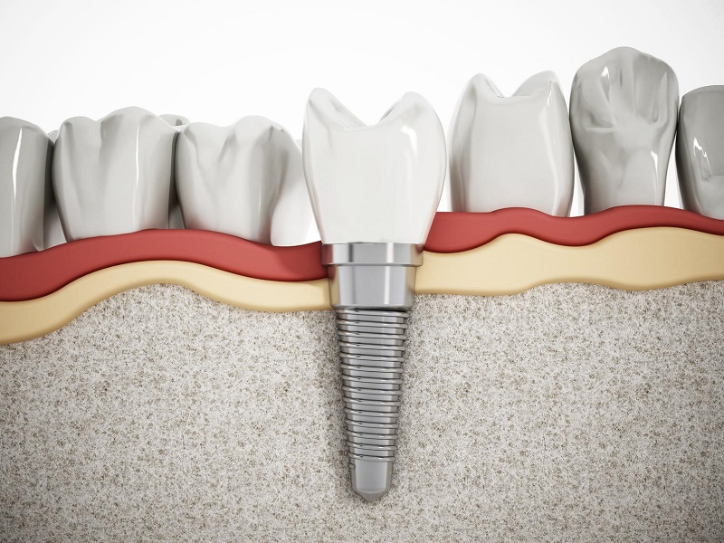 Quy trình niềng sau khi đã trồng Implant gồm