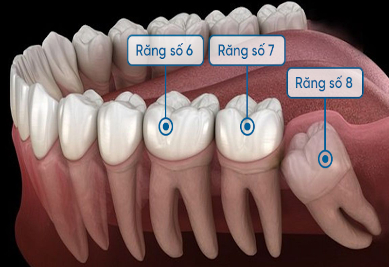 Mất chân răng để lâu có thể gây tiêu xương hàm, tụt nướu,