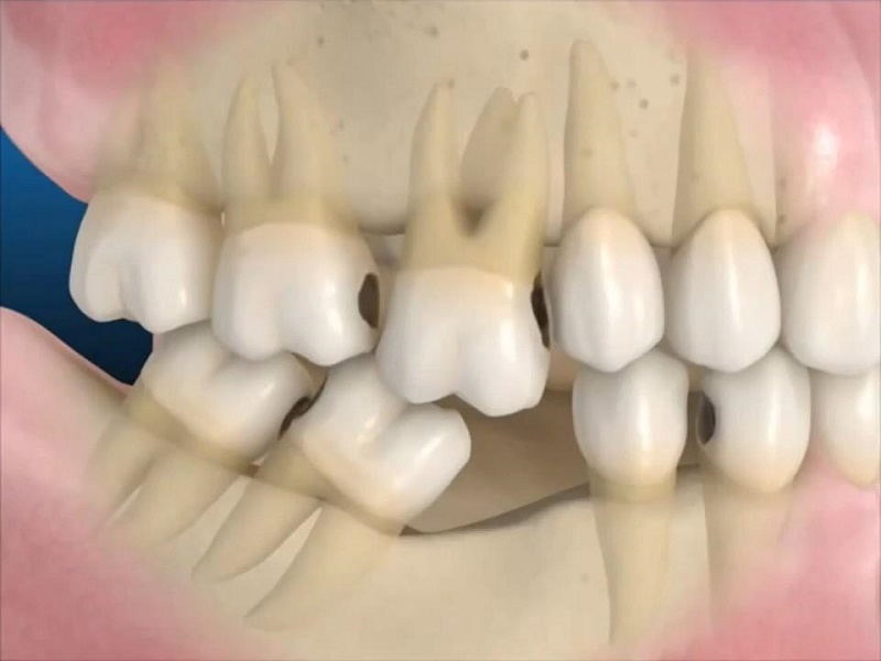 Có những phương pháp nào để trồng răng khi mất chân răng?