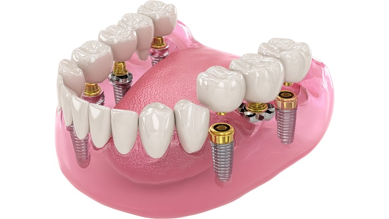 Mất chân răng là tình trạng toàn bộ phần chân răng nằm trong xương hàm bị mất do nhổ răng