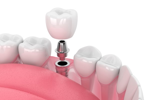 Sở dĩ lúc làm gần như không đau là nhờ hai yếu tố.