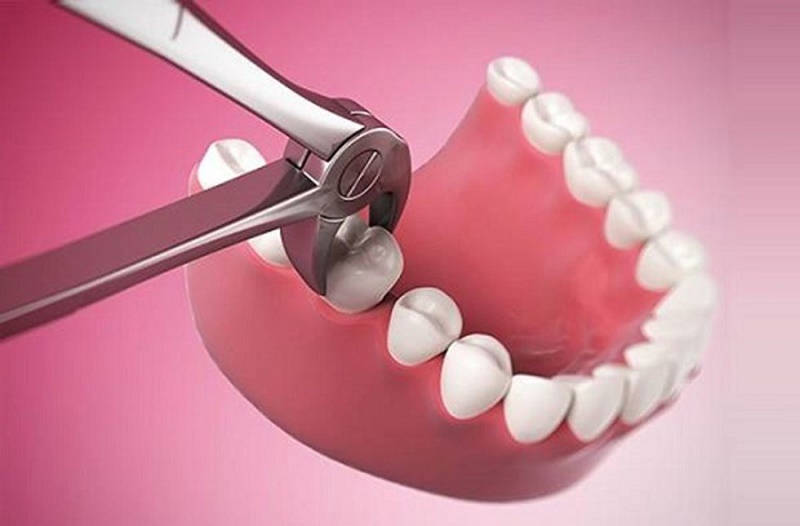 Trường hợp nào trồng răng số 6 đau nhiều hơn?