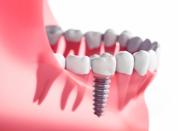 phục hình răng số 6 không cần phẫu thuật cắm trụ,