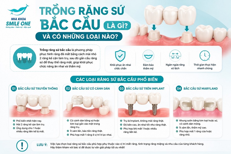 Trồng răng sứ bắc cầu là phương pháp phục hình răng mất bằng cách mài hai răng thật