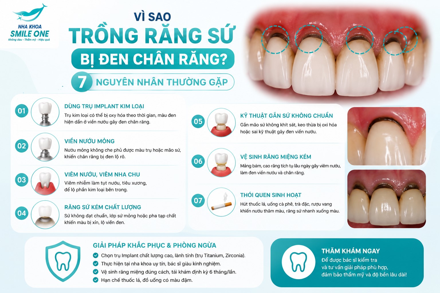 Trồng răng sứ bị đen chân răng thường do dùng răng sứ kim loại bị oxy hóa