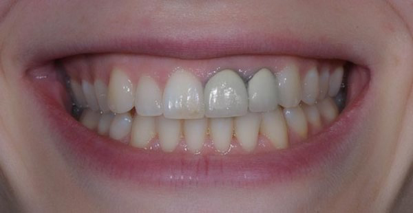 Mão sứ cũ sau khi tháo ra thường không dùng lại được.