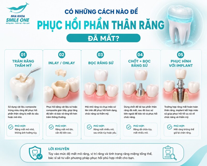 Tùy lượng mô răng khỏe còn lại, bác sĩ có thể lựa chọn trám/tái tạo trực tiếp