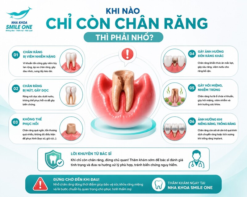 Chân răng thường phải nhổ khi đã hỏng đến mức không còn tạo được một nền phục hồi