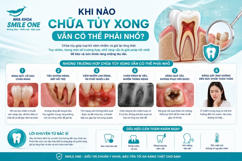 Răng chữa tủy vẫn có thể phải nhổ nếu toàn bộ chiếc răng không còn khả năng phục hồi