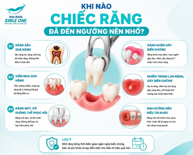 Bác sĩ thường nghiêng về nhổ khi chiếc răng không còn khả năng phục hồi chắc chắn,