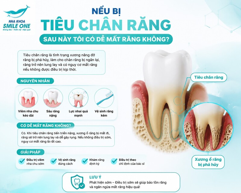Tiêu chân răng không đồng nghĩa chiếc răng chắc chắn sẽ mất.