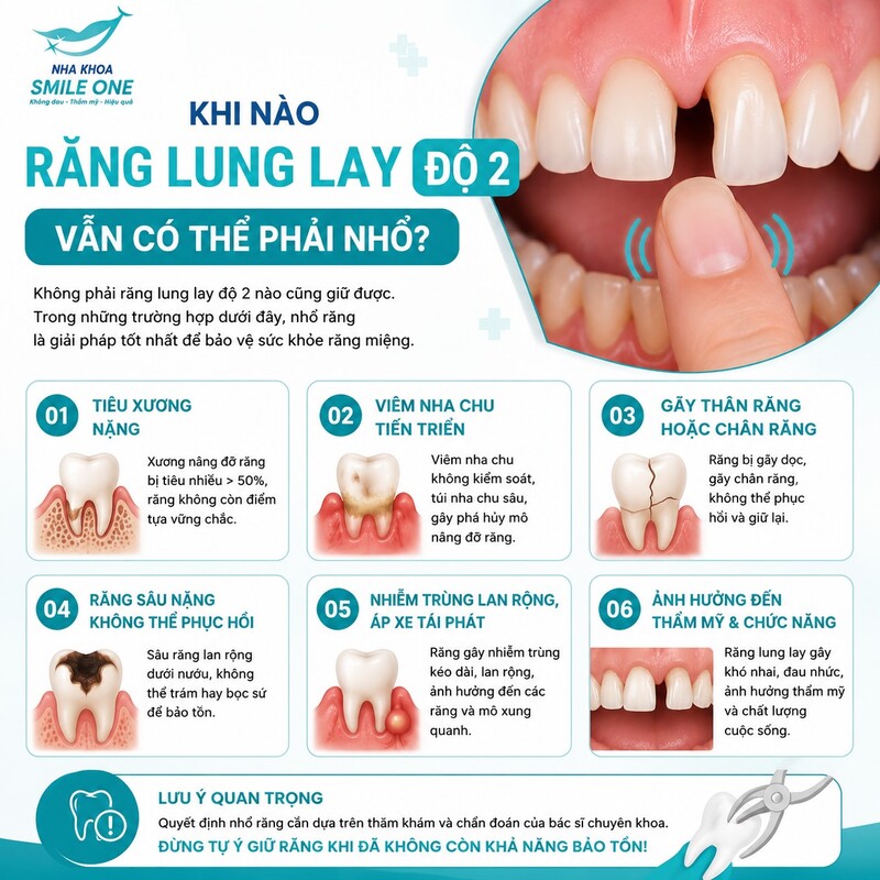 Răng độ 2 vẫn có thể phải nhổ nếu xương – nha chu đã mất nghiêm trọng