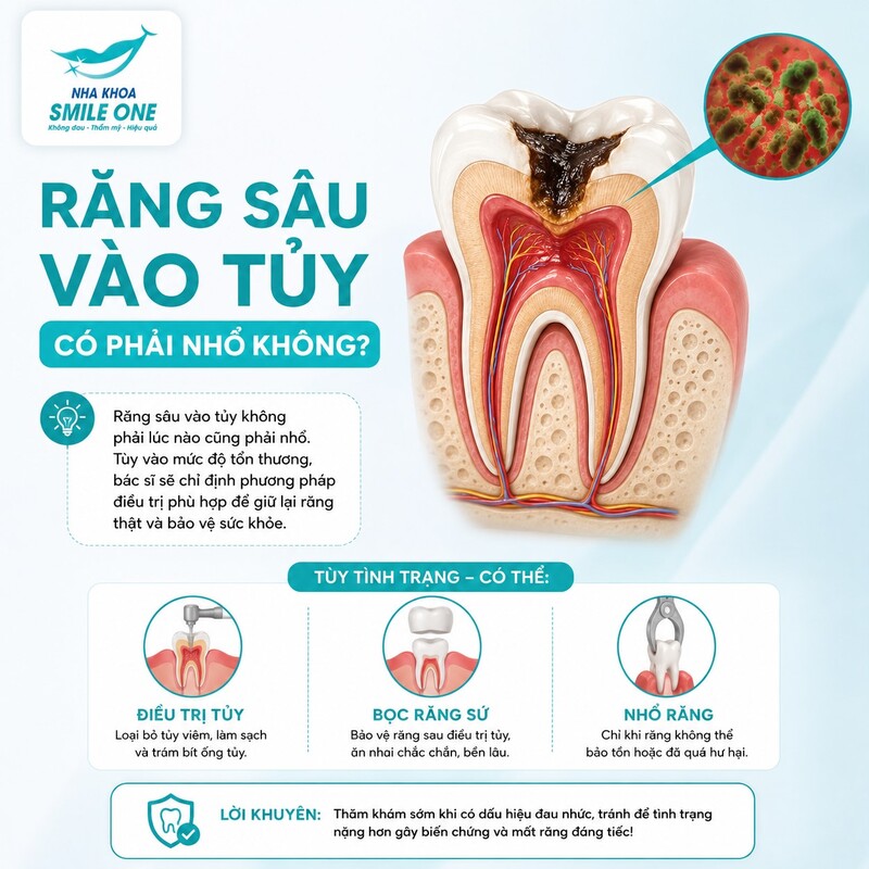 Không. Bác sĩ không quyết định nhổ chỉ vì nhìn thấy một lỗ sâu lớn hoặc vì răng đang đau