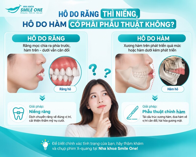 Răng hô hay răng vẩu là dạng sai lệch khớp cắn
