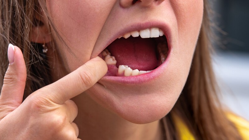 Khi răng số 7 đã nghiêng vào khoảng trống, bác sĩ có thể đi theo hai hướng: