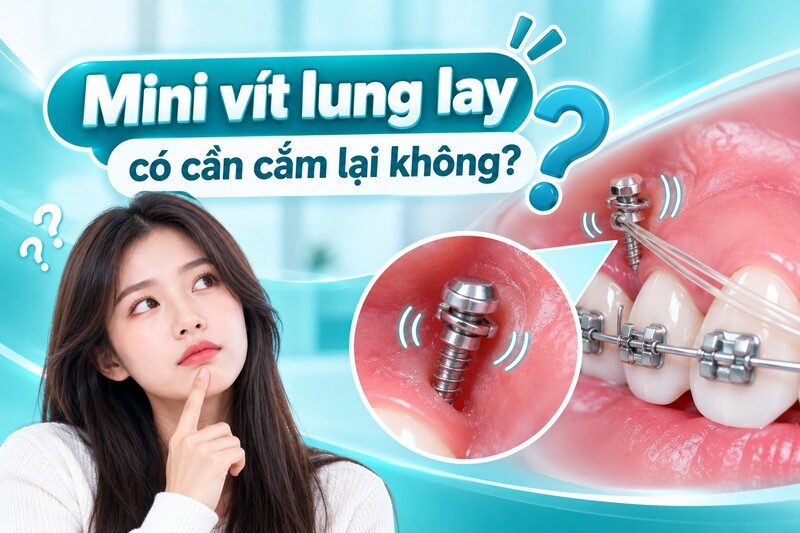Khi mini vít bị lung lay, việc quan trọng nhất là không tự tác động