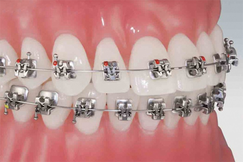 Mắc cài tự buộc đáng để Hoàng Anh cân nhắc nếu ưu tiên sự thoải mái