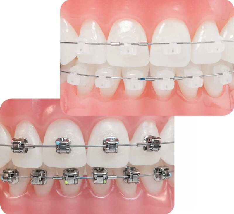 Mắc cài tự buộc có thể giúp tối ưu thời gian điều trị nhờ giảm ma sát