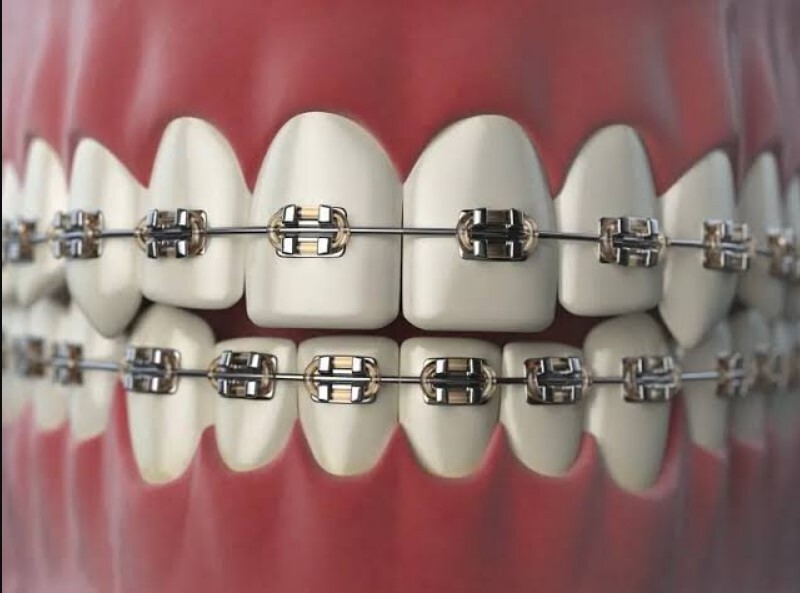 Mắc cài tự buộc nổi bật hơn ở khả năng giảm ma sát,