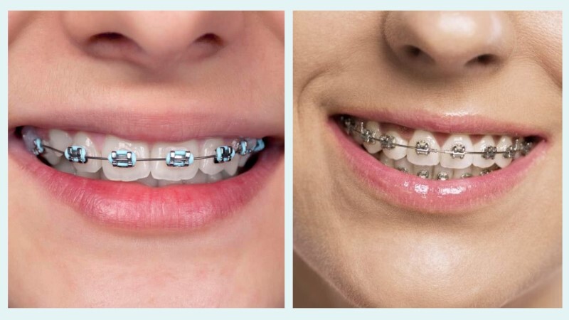 Mắc cài tự buộc tốt hơn mắc cài thường ở nhiều yếu tố về độ thoải mái