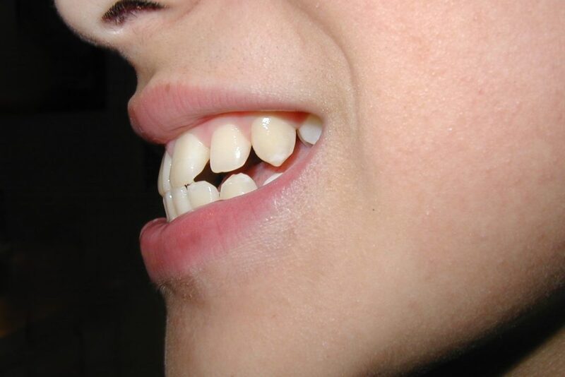 Một trường hợp thực tế tại Nha khoa Smile One là Nguyễn Thị Huệ