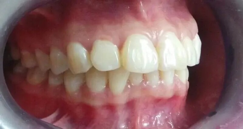 Đây là trường hợp mà chỉnh nha tác động trực tiếp hơn vào nguyên nhân gây hô.