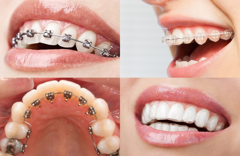 Răng hô nên ưu tiên niềng răng vì phương pháp này giúp dịch chuyển răng