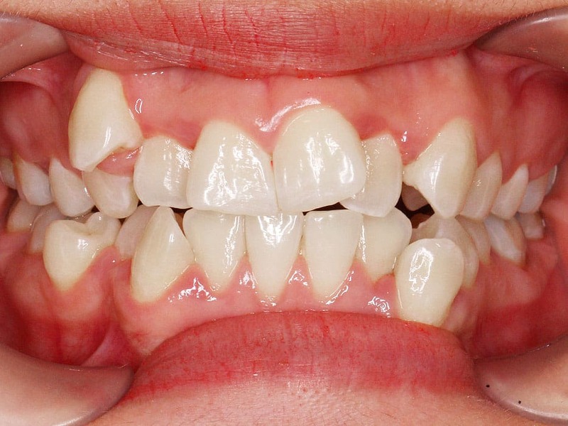 Niềng răng khấp khểnh thường cần khoảng 12–36 tháng