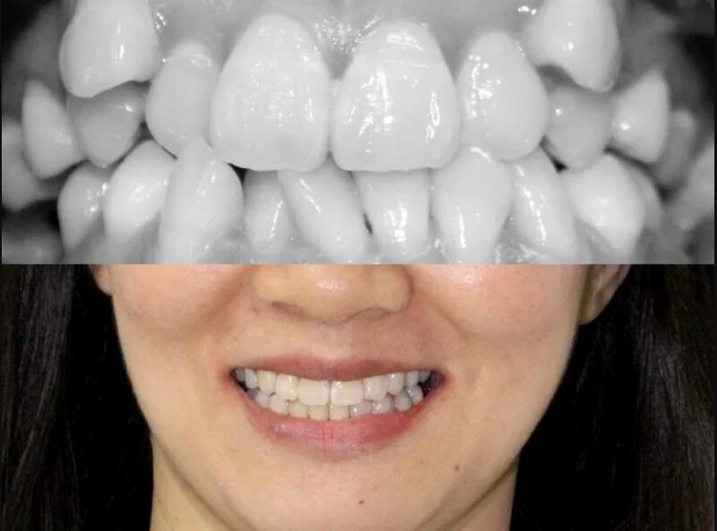Chỉ vài răng cửa mọc lệch vẫn có thể cần niềng toàn diện