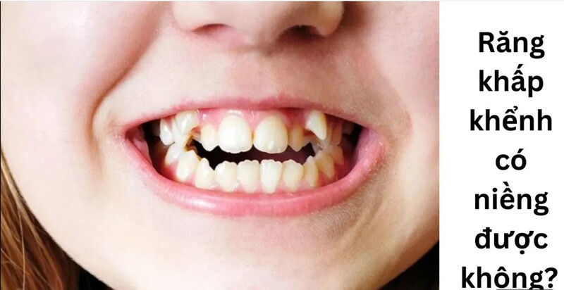 Răng khấp khểnh hoàn toàn niềng được và chỉnh nha